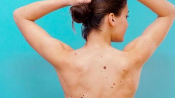 Kadınlarda ki " benler" seksi midir, yoksa itici midir?