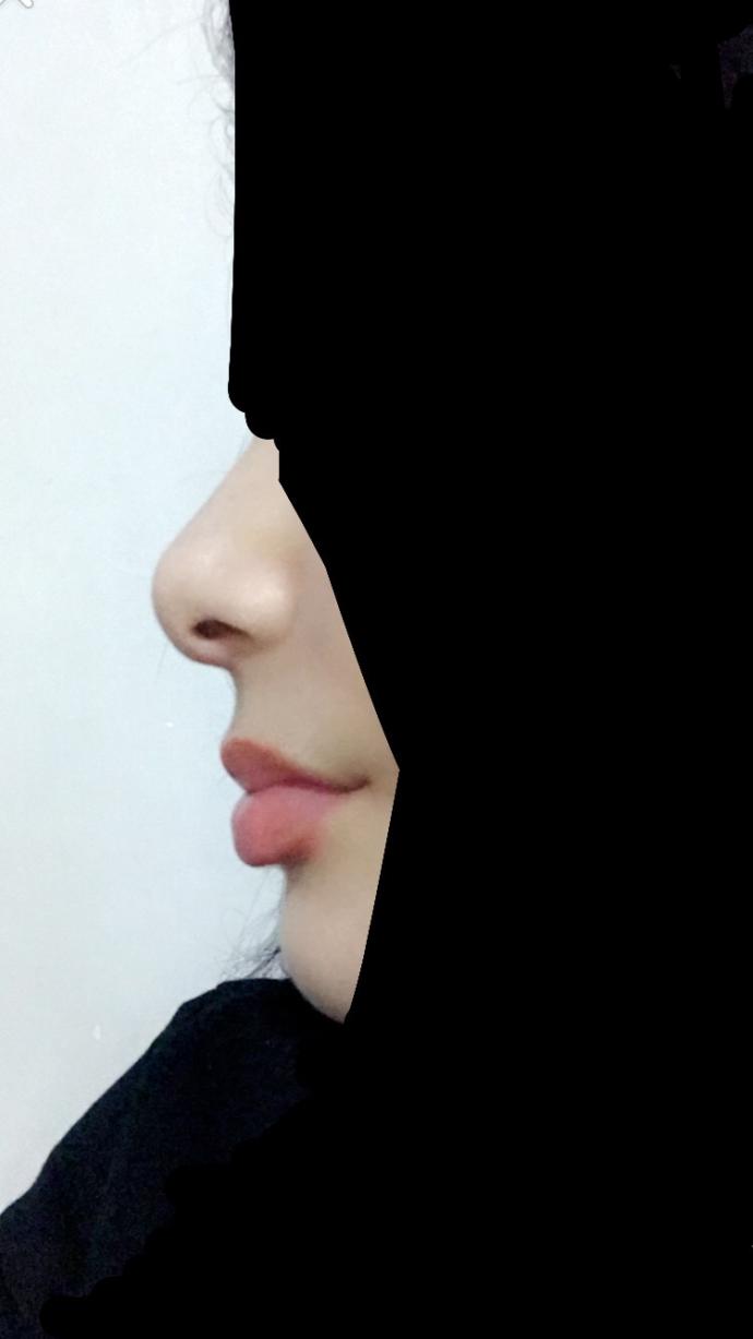 Burun şeklim nedir?