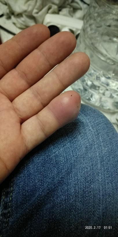 Dolama parmak iltihabı bu gece uyutmadı acıdan uyuyamadım sizce bu nasıl tedavi edilir?