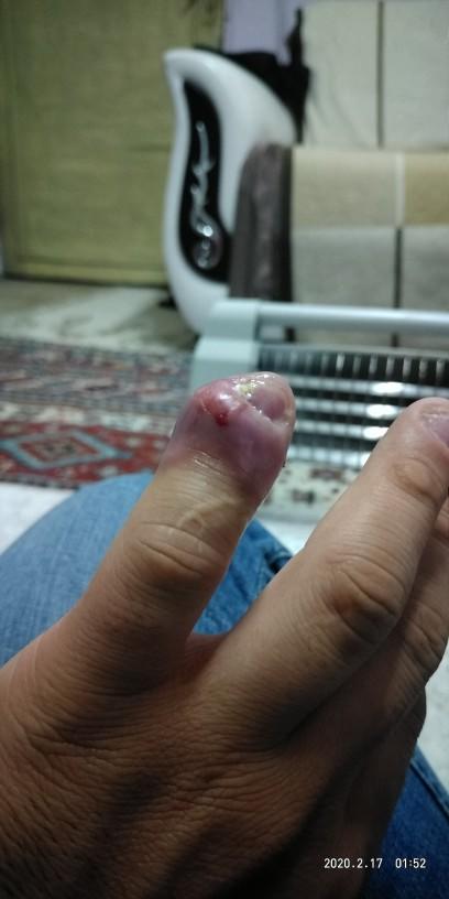 Dolama parmak iltihabı bu gece uyutmadı acıdan uyuyamadım sizce bu nasıl tedavi edilir?