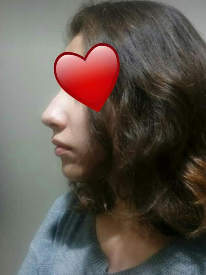 Çene dolgusu ve burun estetiği?
