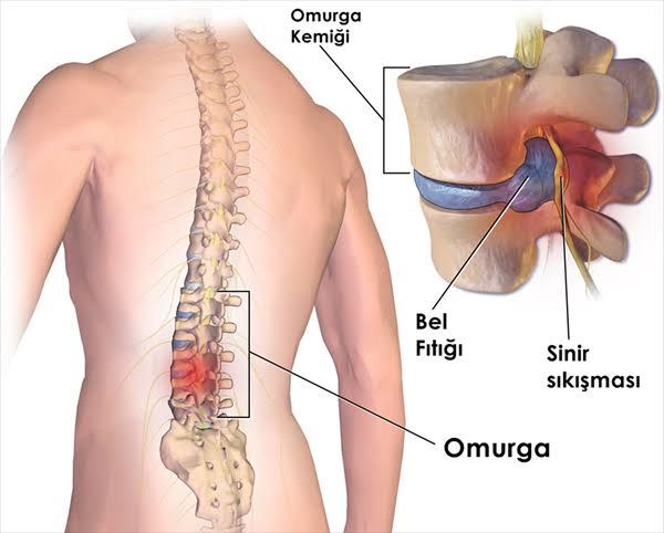 Omzumun, belimin ağrısı bacaklarıma vuruyor, fıtık olabilir mi?