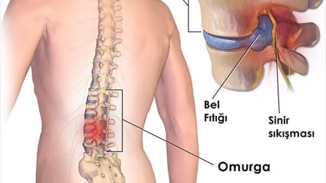 Omzumun, belimin ağrısı bacaklarıma vuruyor, fıtık olabilir mi?