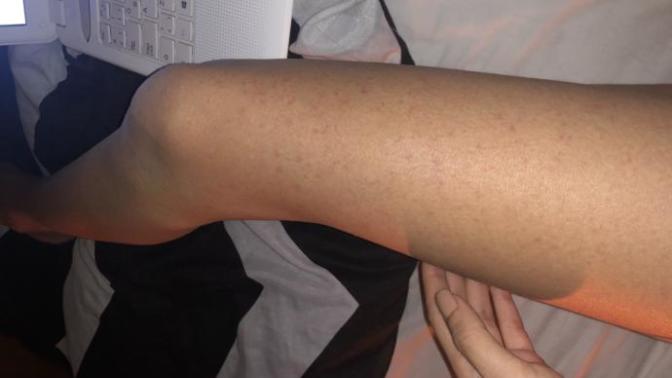 Bactrim antibiyotik sonucunda kızarıklık alerji?