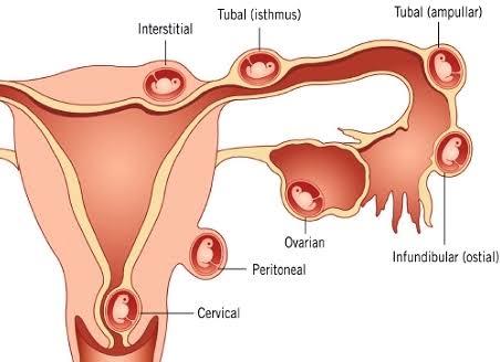 Dış gebelik nedir?
