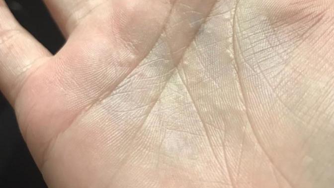 ARKADAŞLAR ACİL BAKAR MISINIZ ELLERİMDE KABARCIKLAR ÇIKIYOR?