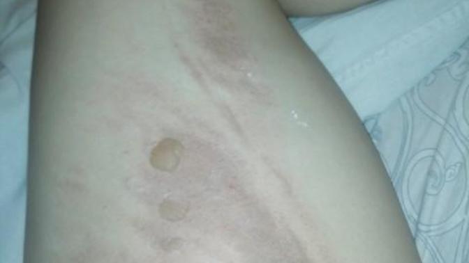 Sıçak çay dökülmesi sonucu ayağım yandı, ne sürersen daha hızlı iyileşir ve izi kalmaz?