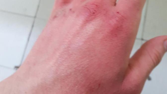 Elimin Bu kadar Çatlaması Normal mi Acaba?
