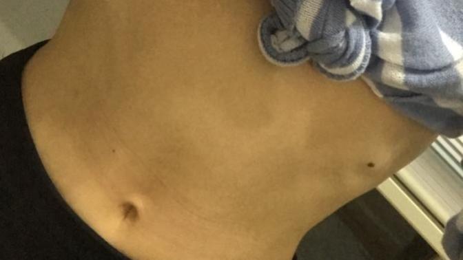 Tam 1 haftadır günde 20 dk karın-bel çalışıyorum, protein ağırlıklı besleniyorum ama alt karnımda şişlik gaz yapıyor ne yapmalı?