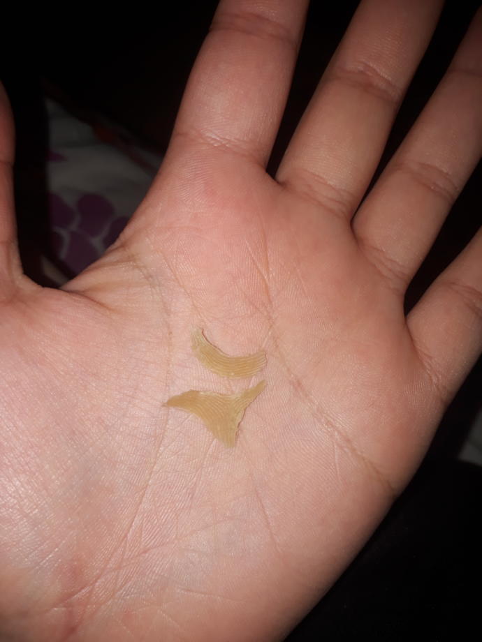 Ayak derimi soydum hem sarı ken de kalın nasır mı tutmuş?