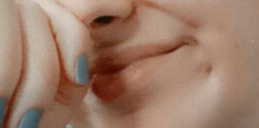 Bu bir gamze midir gamze ise niye cok kucuk?