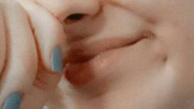 Bu bir gamze midir gamze ise niye cok kucuk?