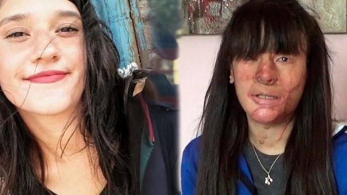 Berfin Özek, yüzünü asitle yakan eski sevgilisini affetti! Ne düşünüyorsunuz?
