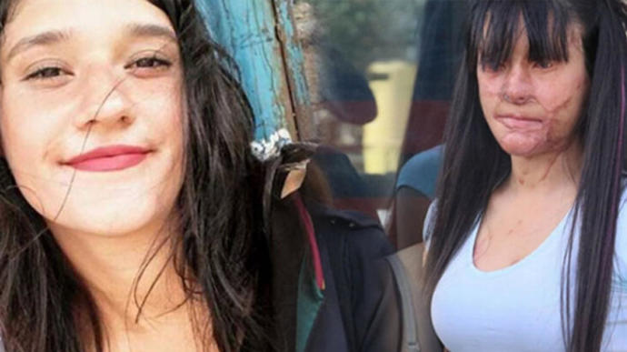 Yüzüne kezzap atılan Berfin; Onu seviyorum, evlenmek istiyorum diyerek şikayetinden vazgeçti. Bu konuda ne düşünüyorsunuz?