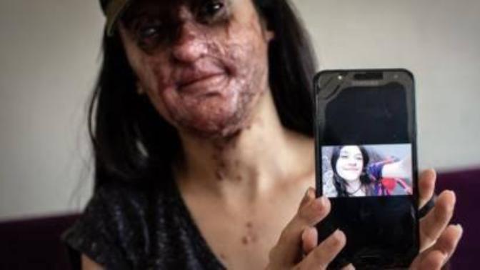 Yüzüne kezzap atılan Berfin Özek 'onunla evlenmek i̇stiyorum' diyerek şikayetini geri çekti. Ne düşünüyorsunuz?