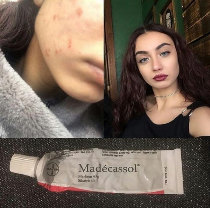 Sivilce izleri için Madecassol nasıl kullanılır?