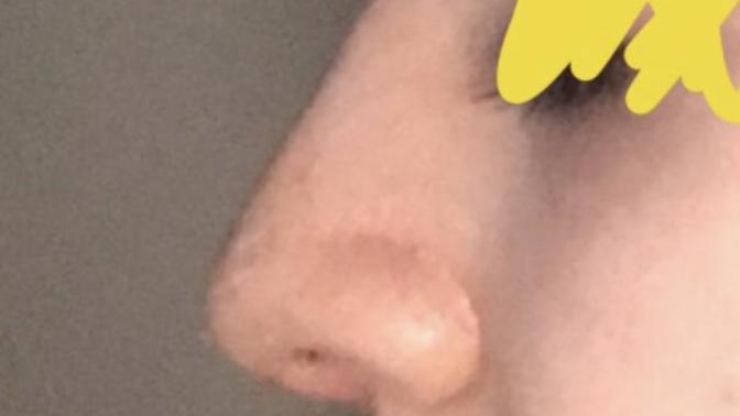 1 ay önce Burun estetiği ameliyatı oldum bunumu beğenmiyorum?