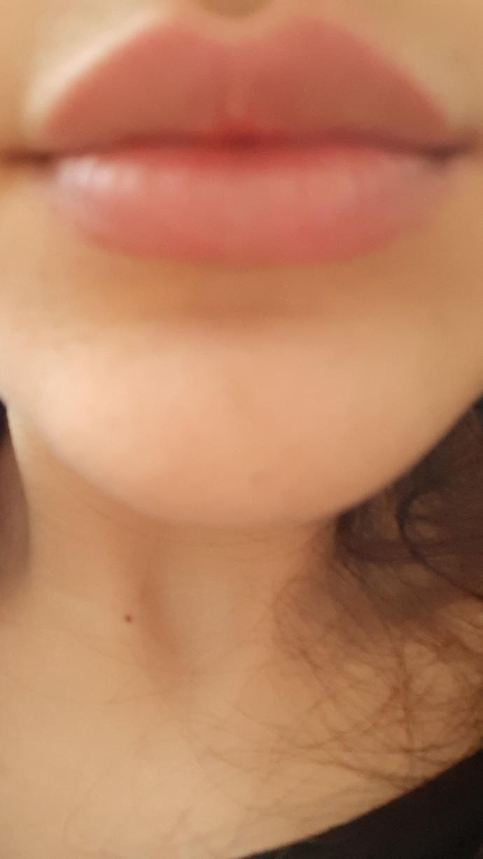 Sizce dudaklarıma botoks yaptırayım mi arkadaşlar yoksa iyi mi?