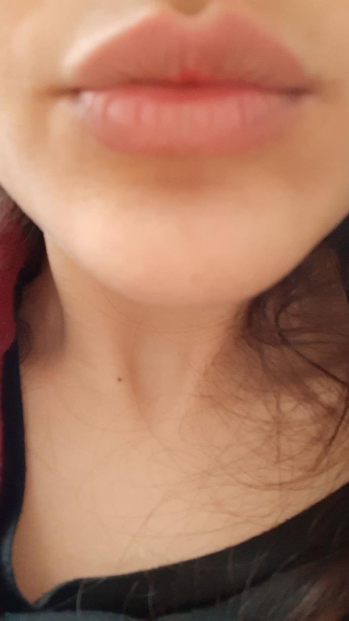 Sizce dudaklarıma botoks yaptırayım mi arkadaşlar yoksa iyi mi?