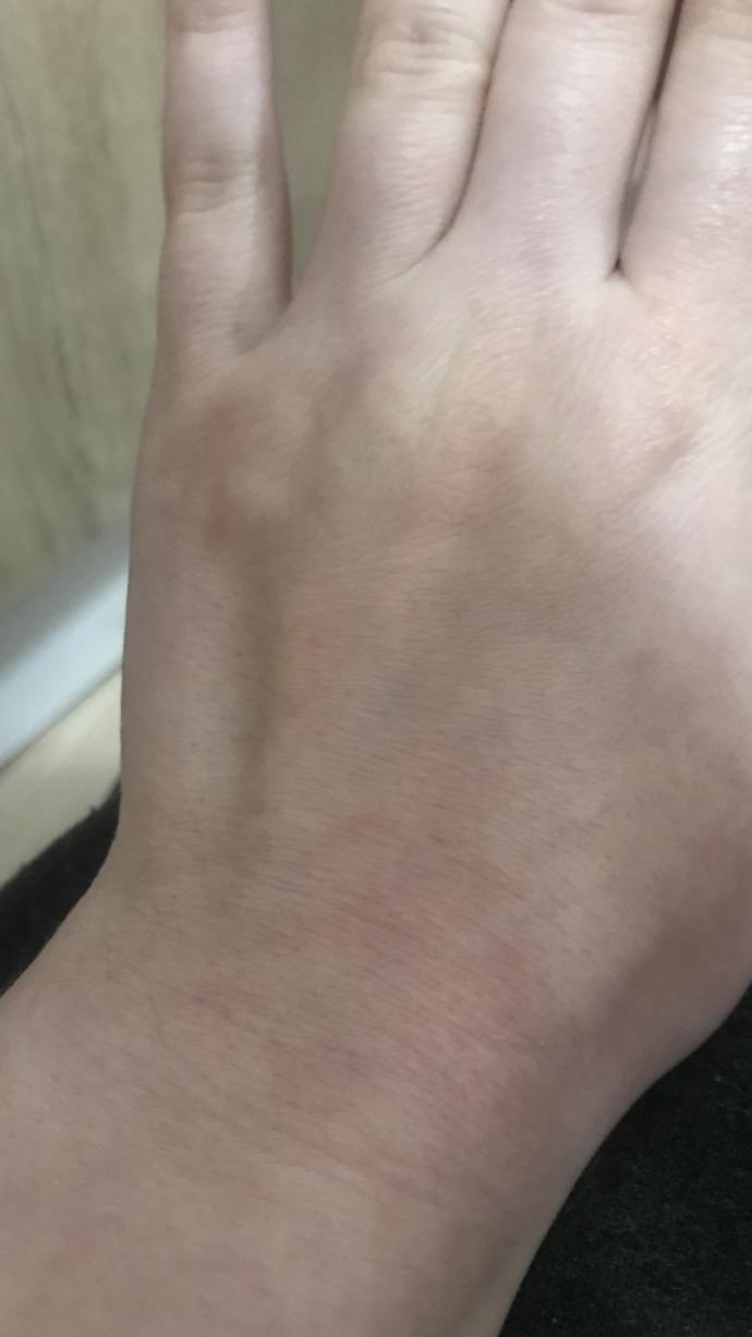 Ellerim kızardı ve acıyor?