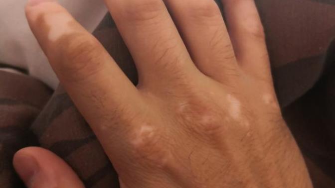 Vitiligo için önerebileceğiniz birşey var mı?