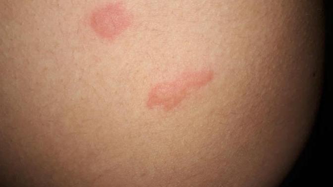 Vücudumda böyle şeyler çıkıyor yeni bir şey değil her yıl oluyor hastaneye gidcektim geçen yıl ailem seneye gideriz dedi neolablr?