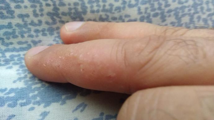Parmağımda küçük beyaz kabarcıklar çıktı, nasıl geçer?