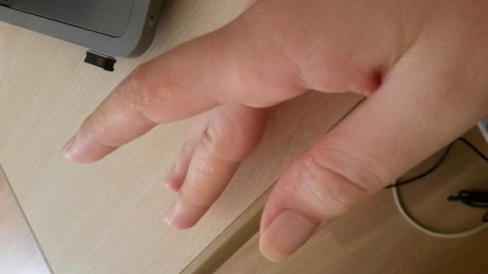 Parmağımda küçük beyaz kabarcıklar çıktı, nasıl geçer?