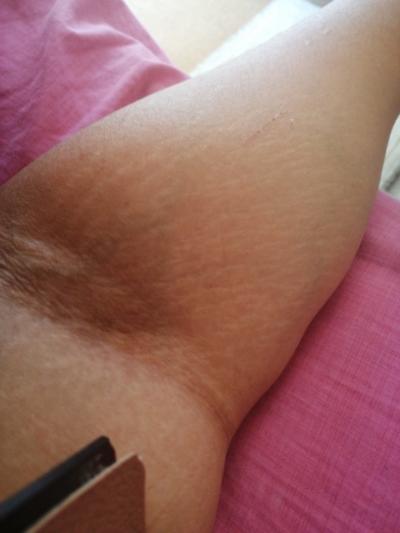 Koldaki Yirtilmalar Sorun Olur Mu Kizlarsoruyor