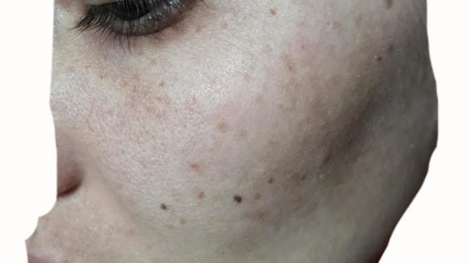 Cilt sorunlarım, Guzellik merkezinden aldığım ürünler ve Kimyasal peeling hakkında?