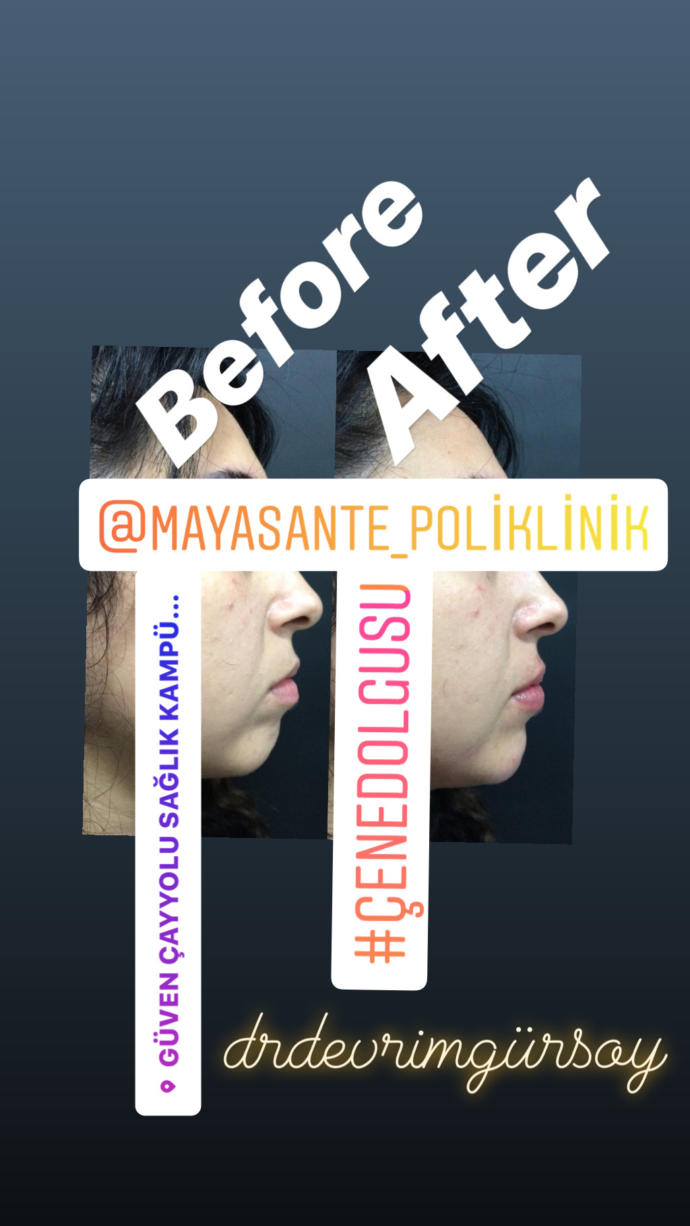 Çene dolgusu nasıl yapılır, fiyat aralığı nedir?
