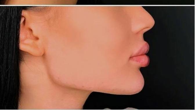 Yeni trendler arasında yer alan çene estetiği hakkında neler düşünüyorsunuz?