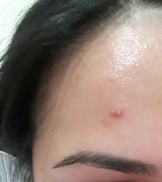Yan yana çıkan şu sivilceleri patlatayim mi?