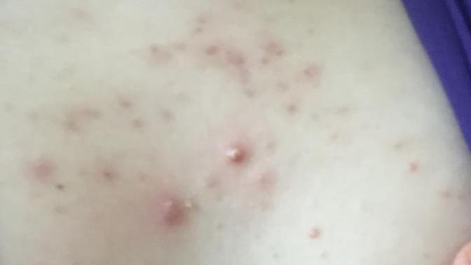 Göğsümde çok sivilce var , nasıl geçirebilirim (Resimli)?