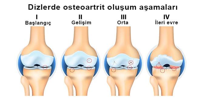 Kireçlenme belirtileri nelerdir, nasıl tedavi edilir?