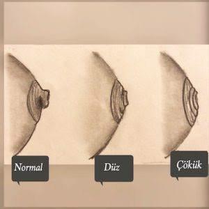 Göğüs ucum çökük bunun için ne yapmalıyım?