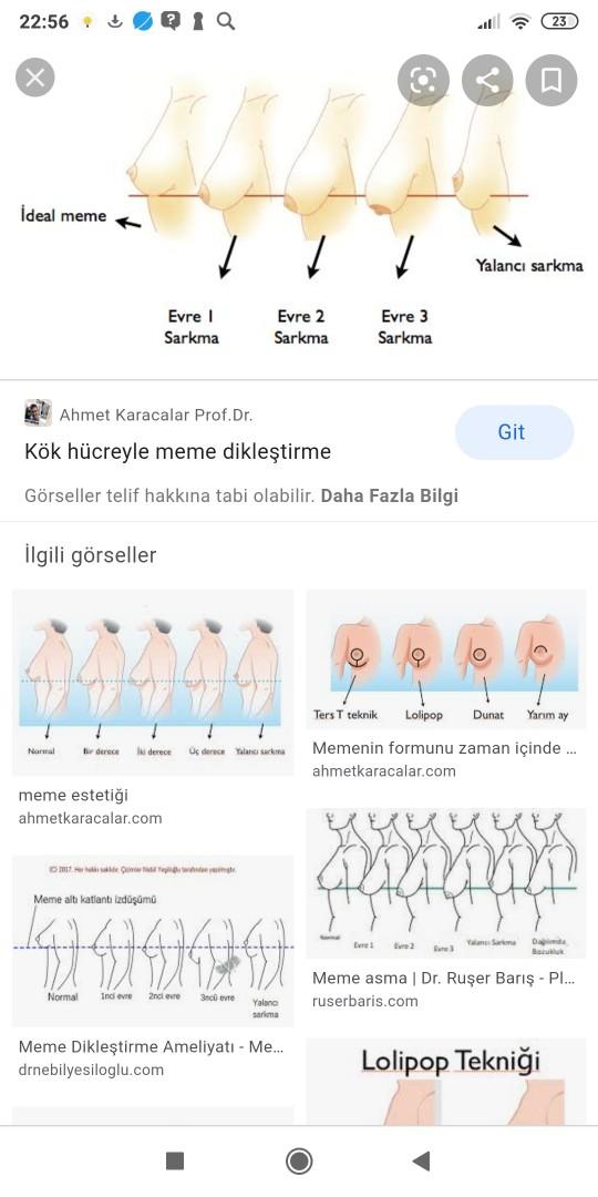 Göğüs sarkması sorunsalı?