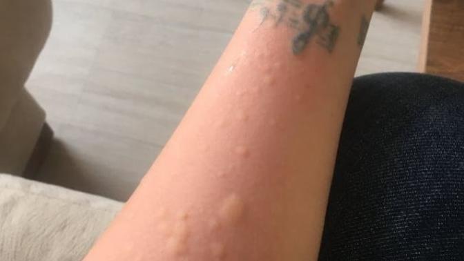 Ağdadan sonra bacağım böyle oldu? Nasıl geçer?