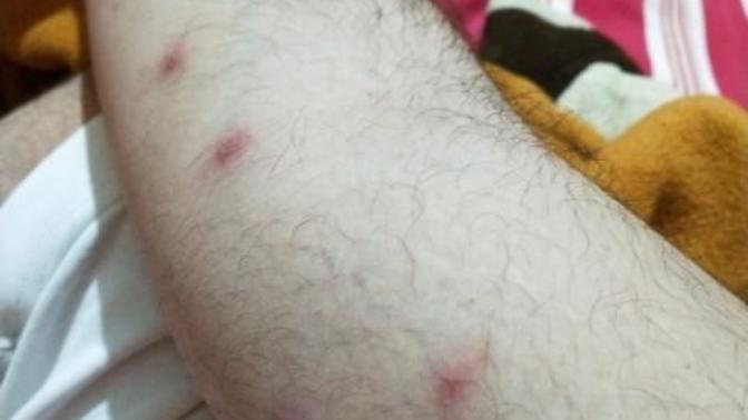 Arkadaşlar bunlar svilcemi? bir gecede çıktı aile hekimi tetradox yazdı bunlar kaç güne geçer?