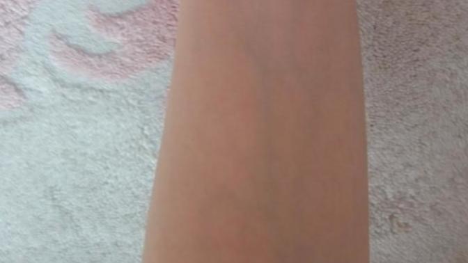 Kızlar bu kadar damar görünmesi normal mi?