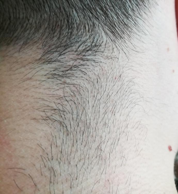 Gecen sene lazer epilasyon yaptırdım, tüy olmayan yerden kıl çıktı, görüntü rahatsız edici mi, çözüm ne?