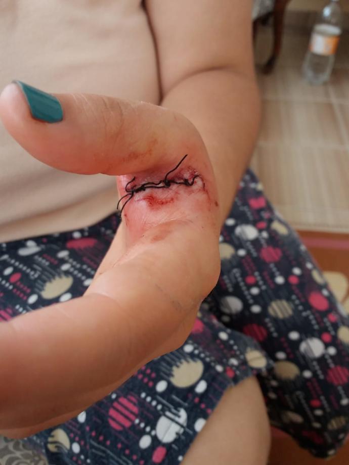 Elime 4 dikiş atıldı ve sevgilim abartma diyor, normal mi bu?