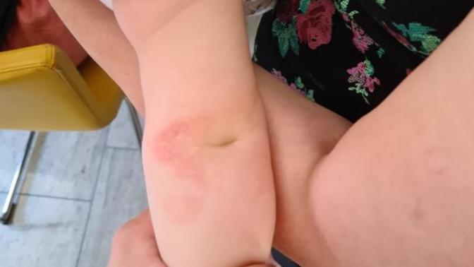 Kızımın kollarında mantar gibi şeyler çıktı, ne olabilir?