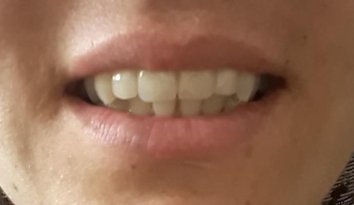 Zirkonyum kaplama yaptırdım ve bunu cok uzun süredir bekliyordum ama sonucu begenmedim moralim çok bozuldu?