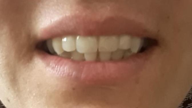 Zirkonyum kaplama yaptırdım ve bunu cok uzun süredir bekliyordum ama sonucu begenmedim moralim çok bozuldu?