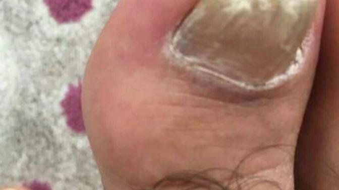 Arkadaşlar ayak, tırnak mantarına ne yapmak gerek?