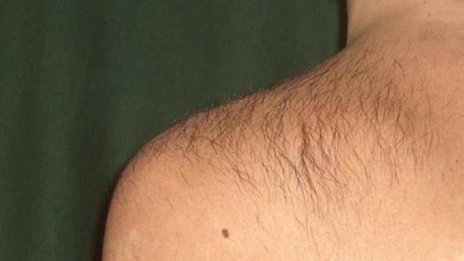Daha önce enseme ve omuzlara lazer epilasyon deneme atışı yaptırdım. Kıllar çok yoğunlaştı. Devam etmem şart mı? Bitirir mi?