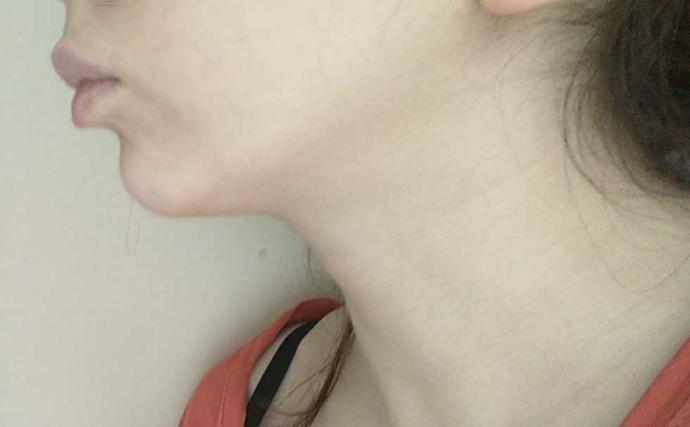 Çene geriliğimi nasıl tedavi ettirebilirim (fotoğraflı)?