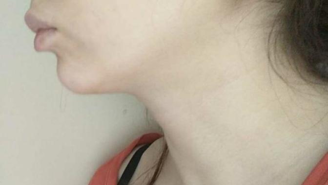 Çene geriliğimi nasıl tedavi ettirebilirim (fotoğraflı)?