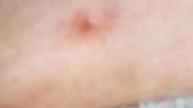 Bunlar ne olabilir stresten mi alerji mi?